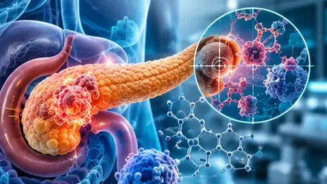 Medical scientific representation of the pancreas with an early lesion and molecular research into cancer interception